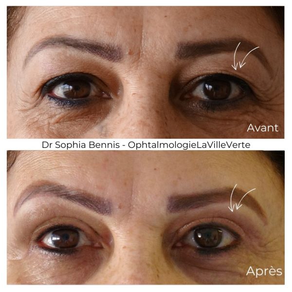 1. AVANT-APRES BLEPHAROPLASIE SUPERIEURE
