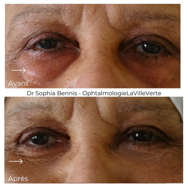 2. AVANT - APRES BLEPHAROPLASTIE INFERIEURE