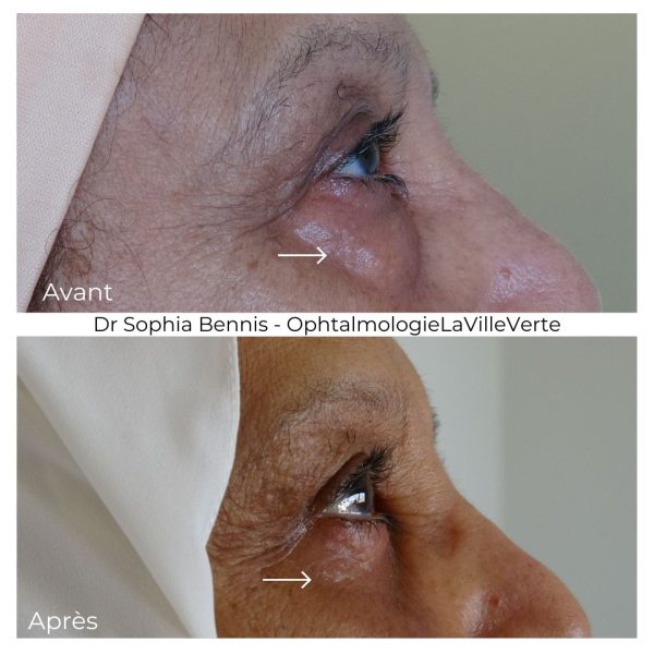 2.1 AVANT-APRES BLEPHAROPLASTIE INFERIEURE