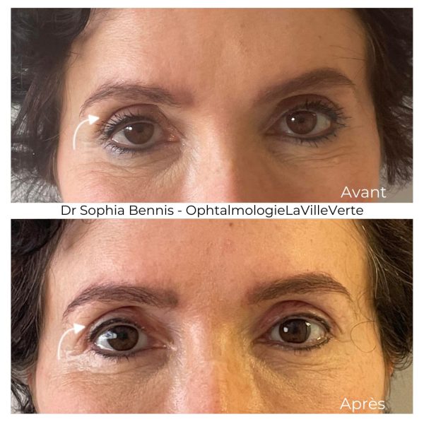 3. AVANT-APRES-CHIRURGIE-PTOSIS