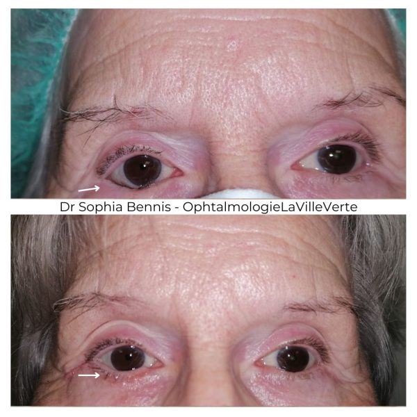 4. AVANT-APRES CHIRURGIE ENTROPION
