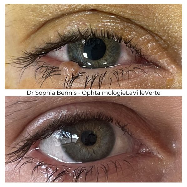 5. AVANT-APRES-TUMEURS-PAUPIERES