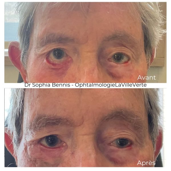 6. AVANT-APRES-TUMEUR-COMPLEXE- PAUPIERES