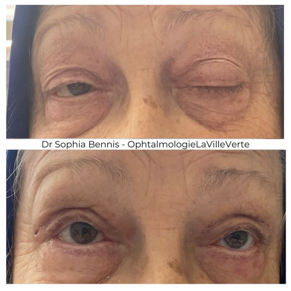 7. AVANT-APRES-CHIRURGIE-PTOSIS-COMPLEXE