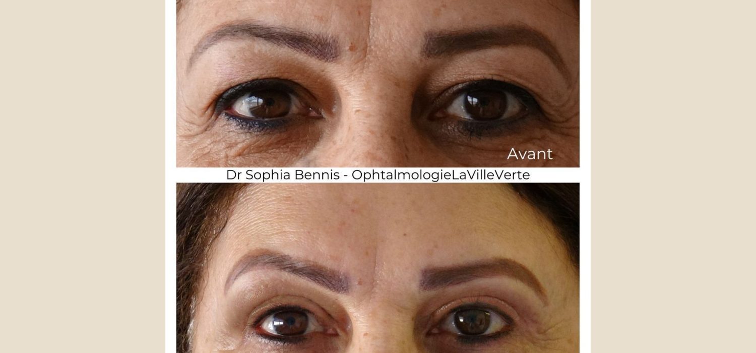 Blepharoplastie-avant-apres-dr-sophia-bennis