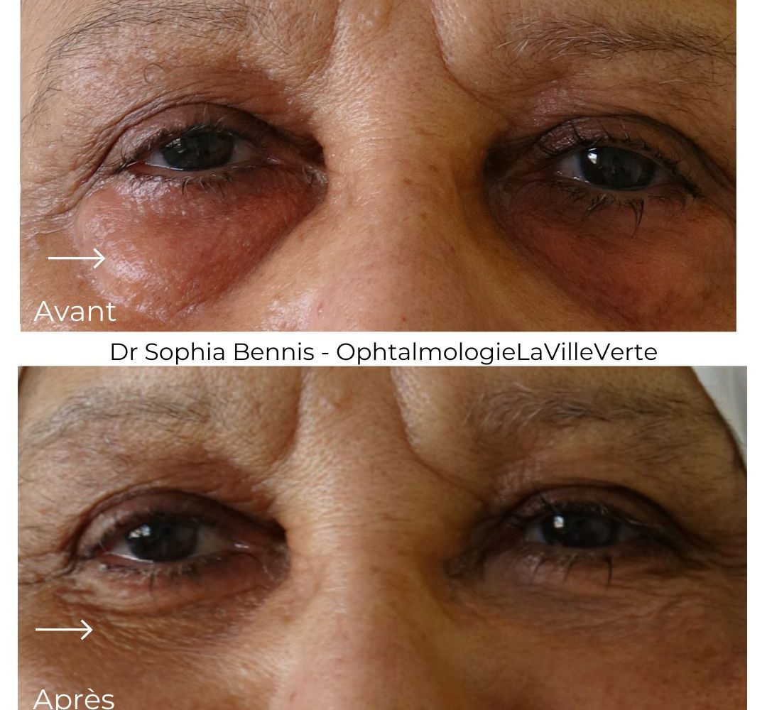 blepharoplastie-inferieure-dr-sophia-bennis