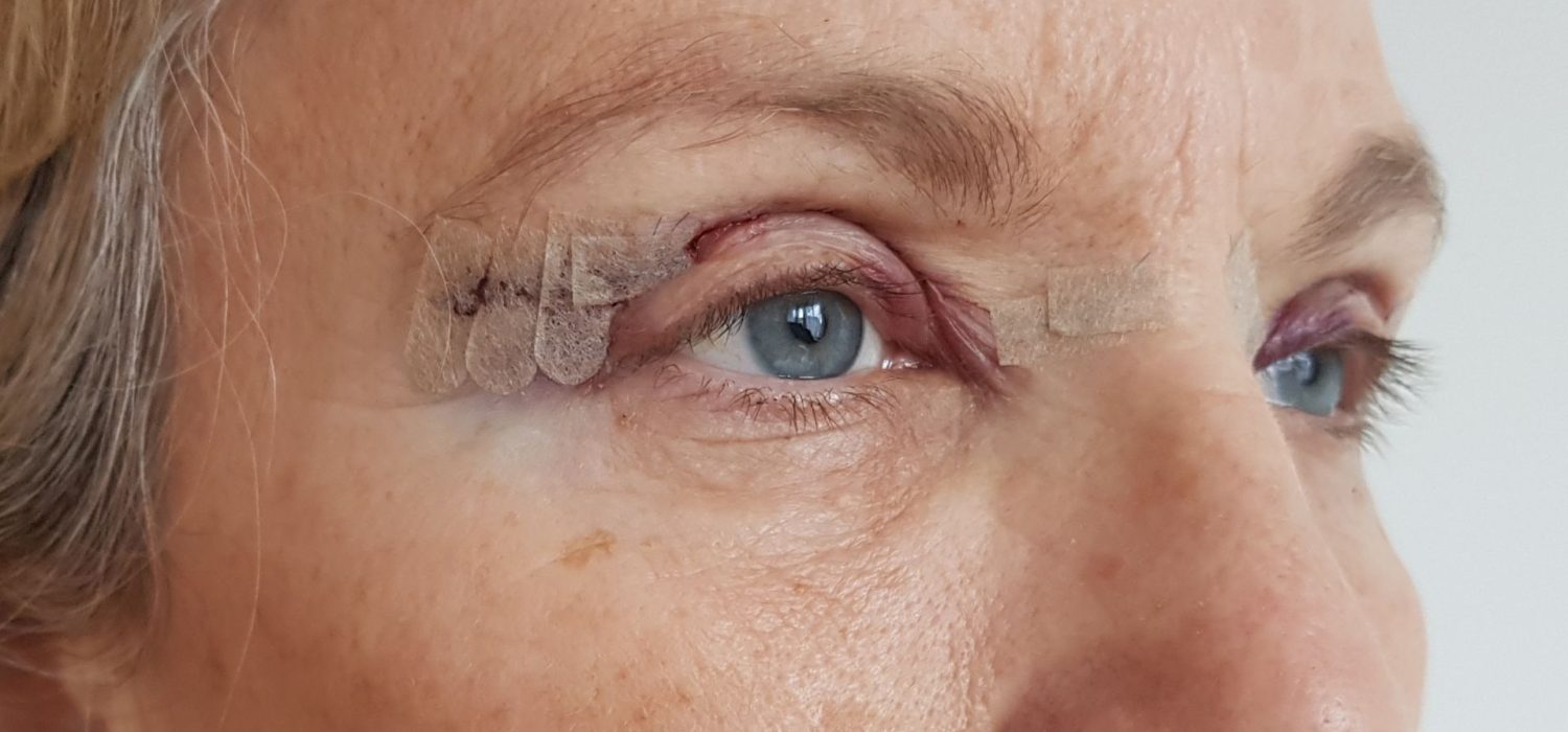 blepharoplastie-paupiere-superieure