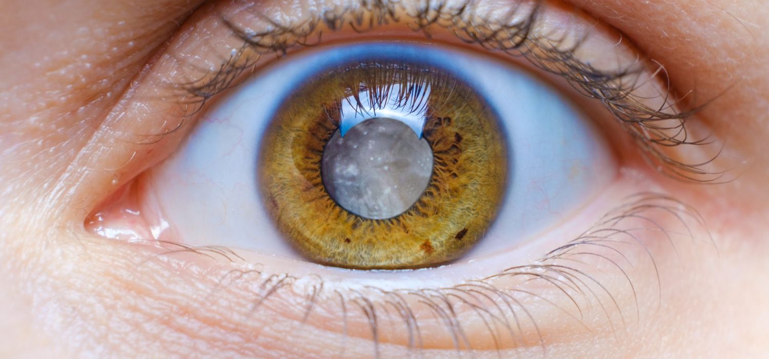 cataracte-chirurgie-des-casablanca