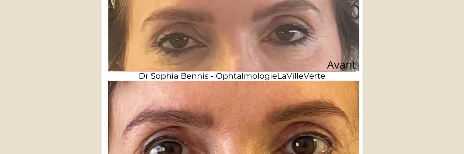 chirurgie-de-ptosis-dr-sophia-bennis