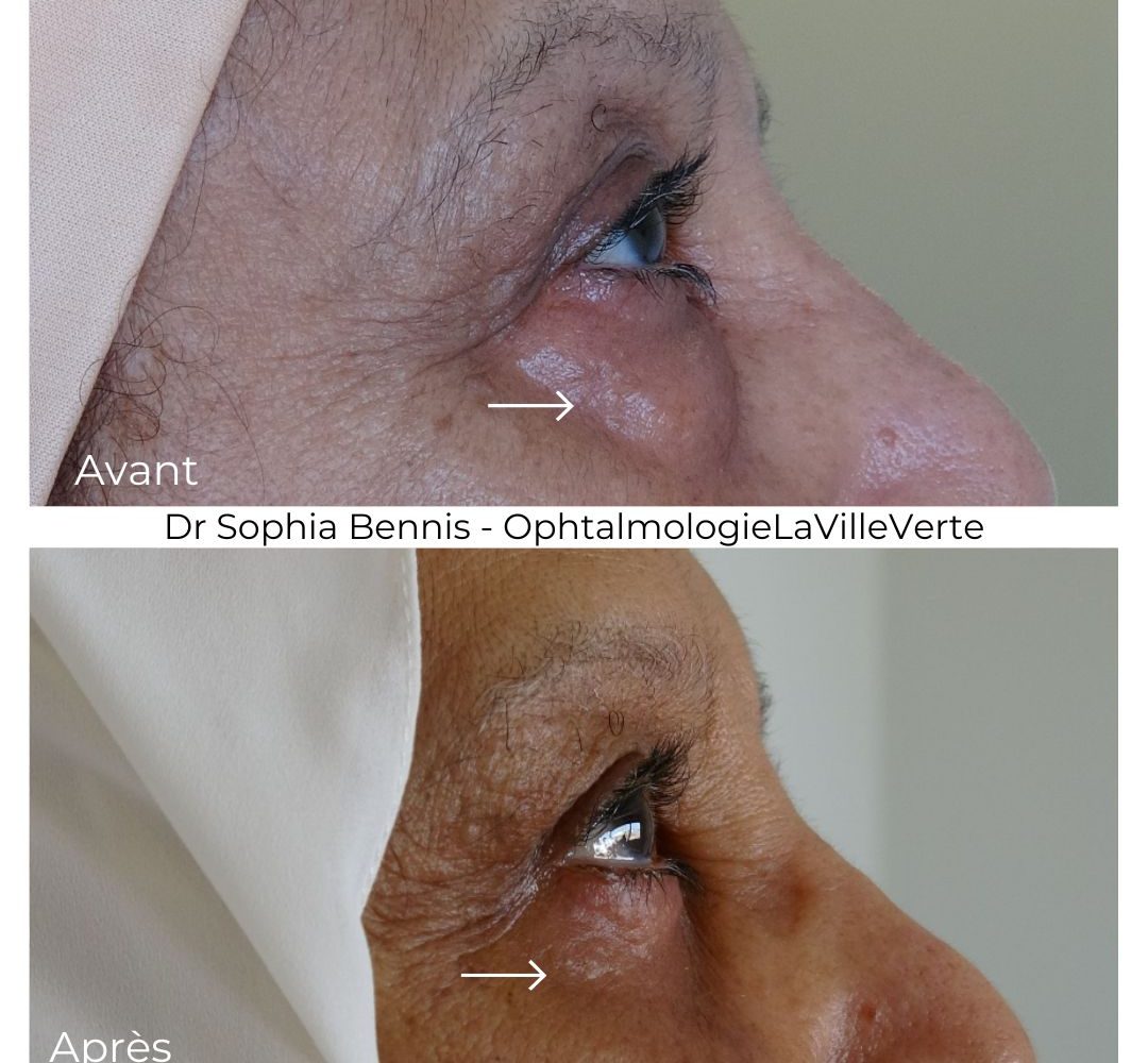 chirurgie-poches-casablanca