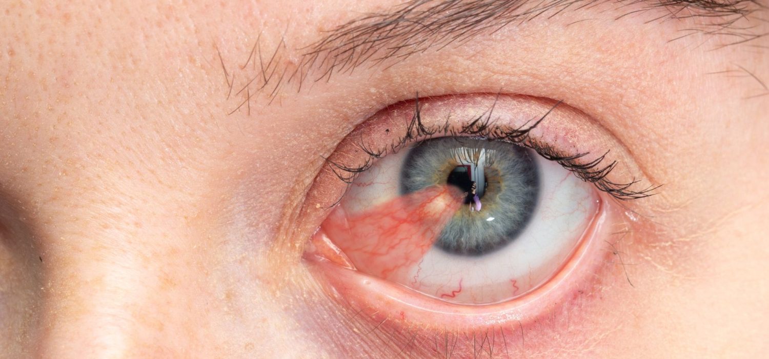 chirurgie-ptérygion-casablanca-dr-sophia-bennis