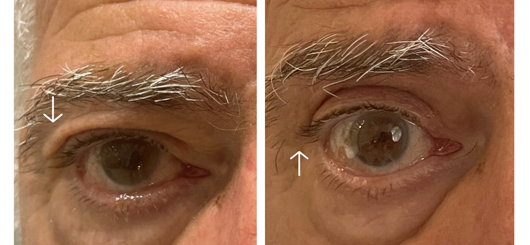 chirurgie-ptosis-blepharoplastie-casablanca