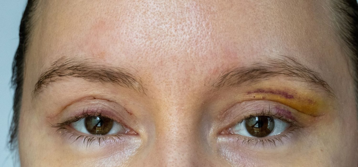 dr-sophia-bennis-blepharoplastie.jpg