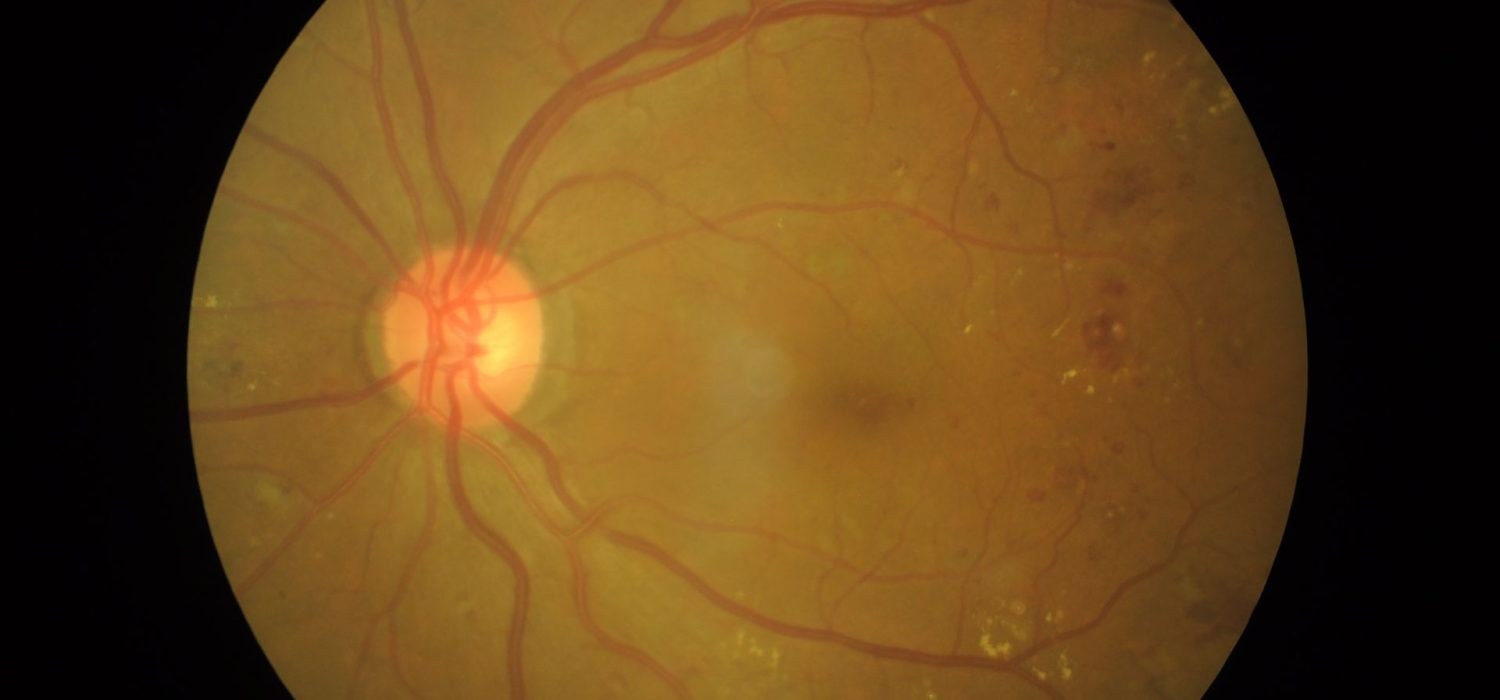 fond-doeil-retinopathie-casablanca