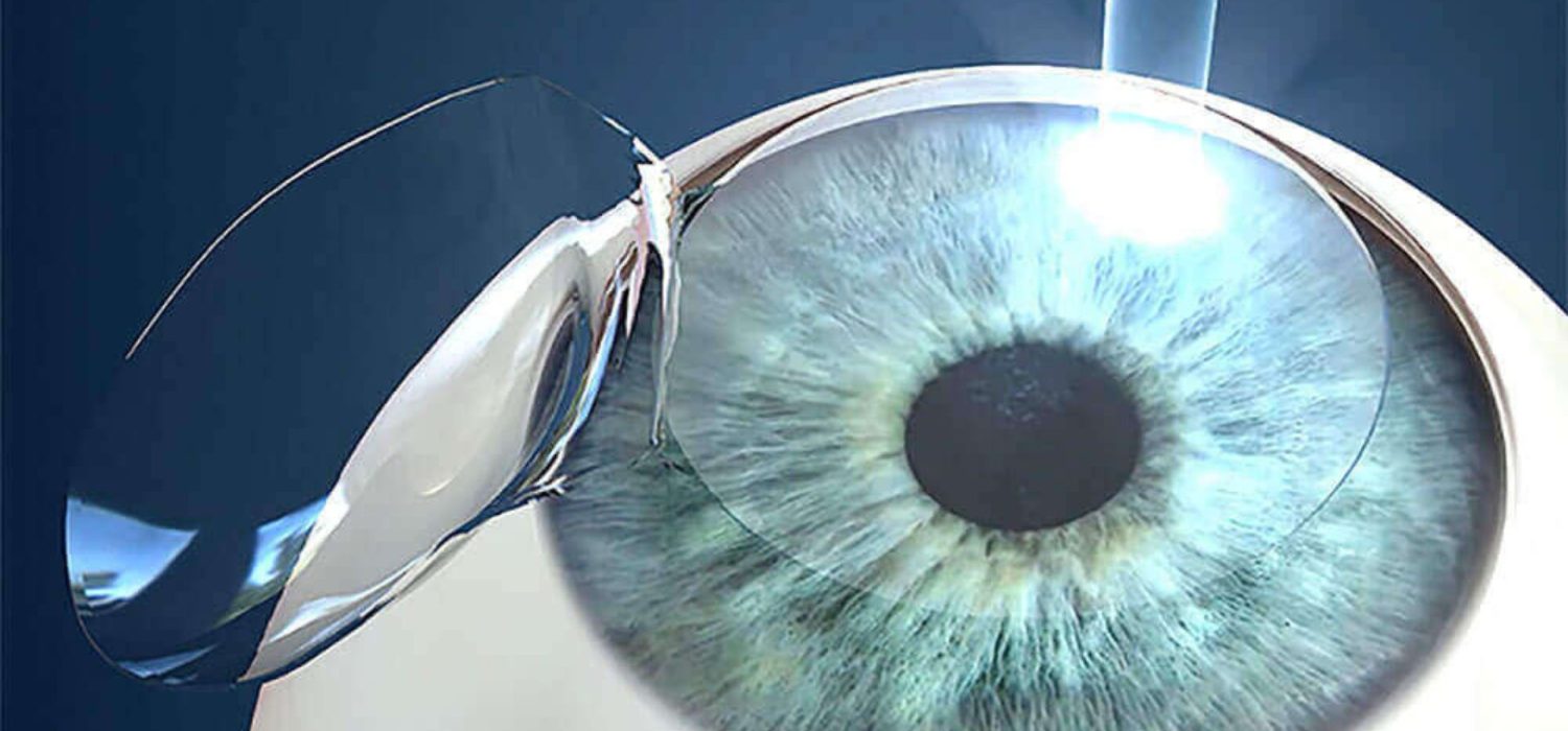 lasik-laser-enlever-lunettes