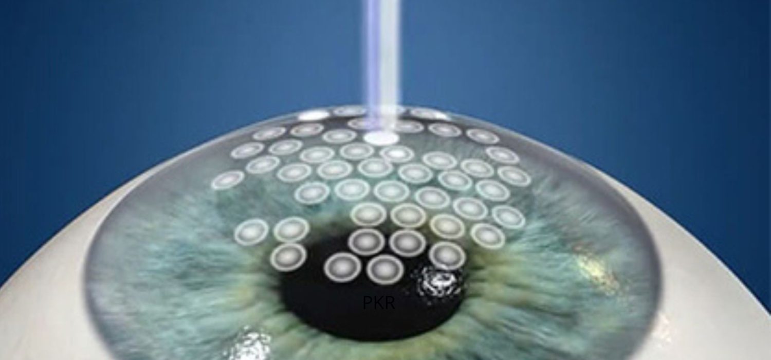 pkr-laser-pour-les-yeux