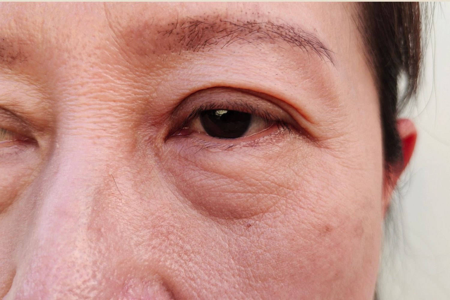 poches-paupieres-inferieures (1)