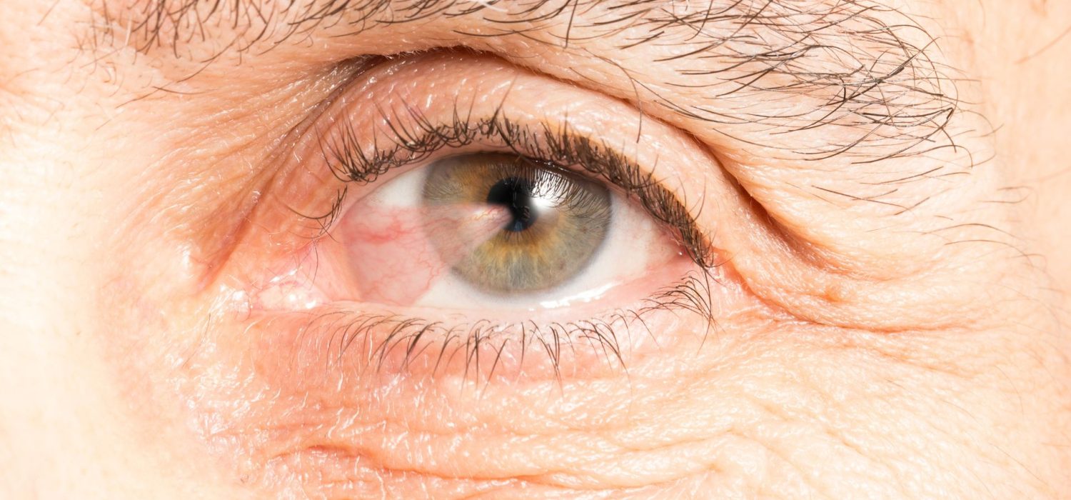 pterygion-chirurgie-casablanca