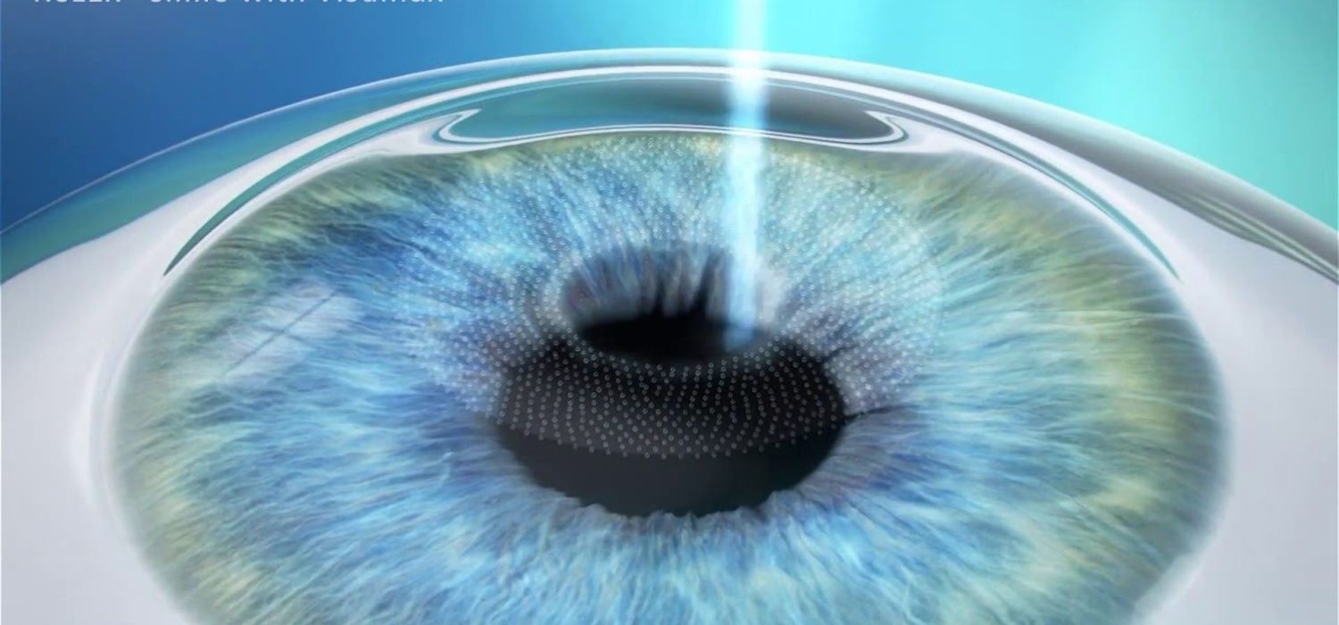 smile-laser-casablanca